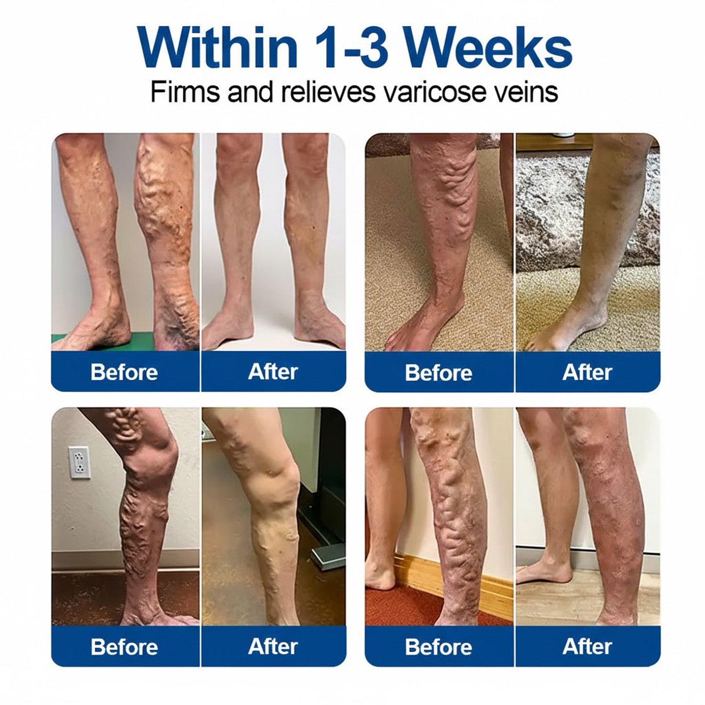 Rivnora®Vein Ease Microneedle Care Patch Instant Relief, Long-Term Results