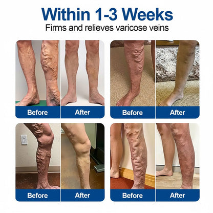 Rivnora®Vein Ease Microneedle Care Patch Instant Relief, Long-Term Results